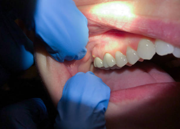 Best Emergency Wisdom Tooth Extraction in Newton, MS